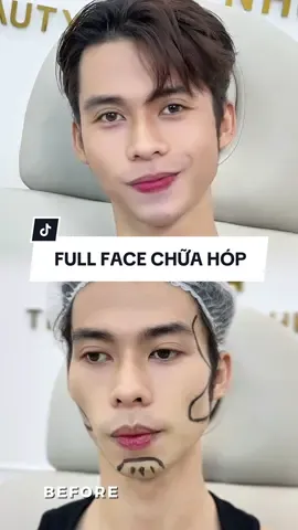 Làm xong tưởng đâu 2 người luôn đó 😍 #xuhuong #beauty #tranthainhutbeauty #cằm #jawline #fullface 