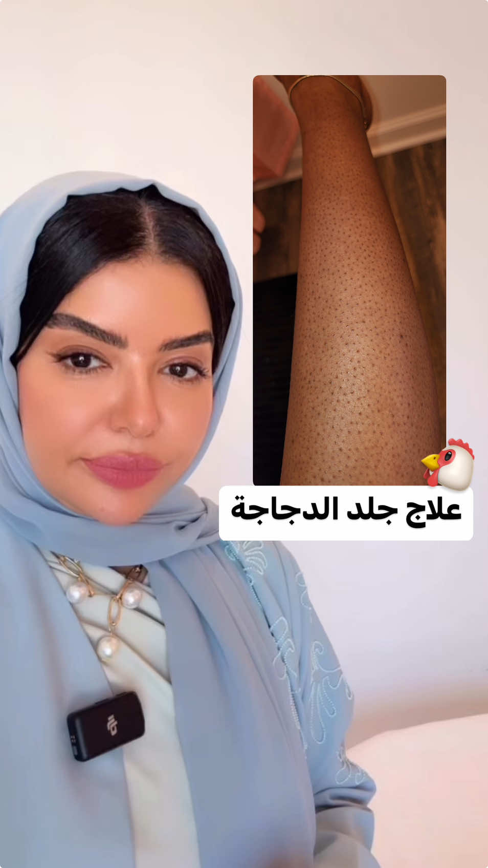 جلد  الدجاجة او KP  من المشكلات المزعجة للكثيرين مع ان علاجها بسيط ويحتاج فقط المواضبة #SKIN#KP #skincareroutine #skincaretips #جلدالوزة #جلدية #جلد_الدجاجة #skincare #beauty #foryou 