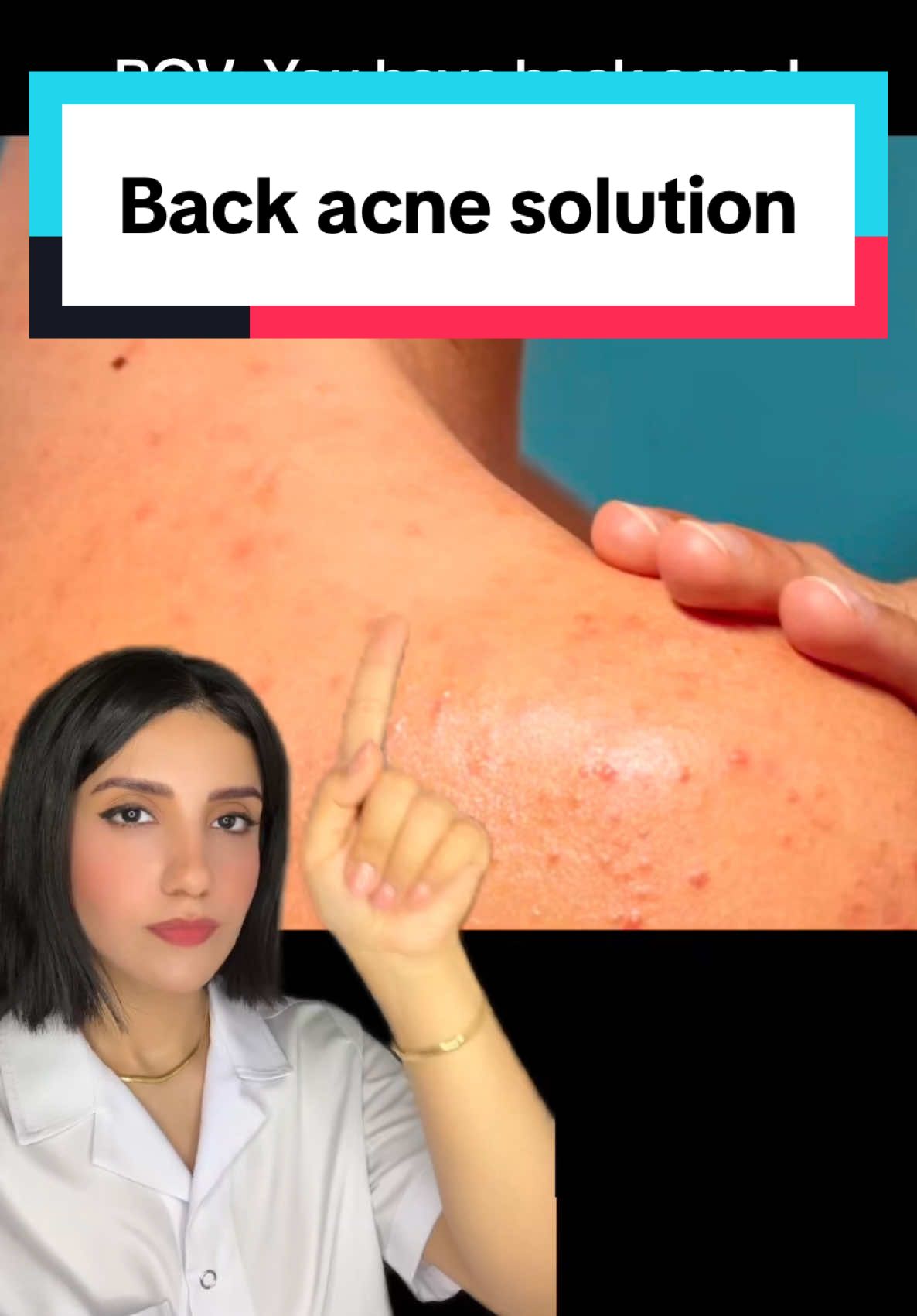 PanOxyl & Salicylic acid cleanser are two potent options for treating back acne, both formulas target bacteria and clogged pores. Start slowly to gauge skin sensitivity, rinse thoroughly, and moisturize to prevent dryness. With consistent use, they can effectively reduce back acne, leading to clearer skin over time. #backacne #acne #bodyacne #acneskin #acnesolution #acnefighter #acneproneskin #acnecare #panoxyl #skincare 