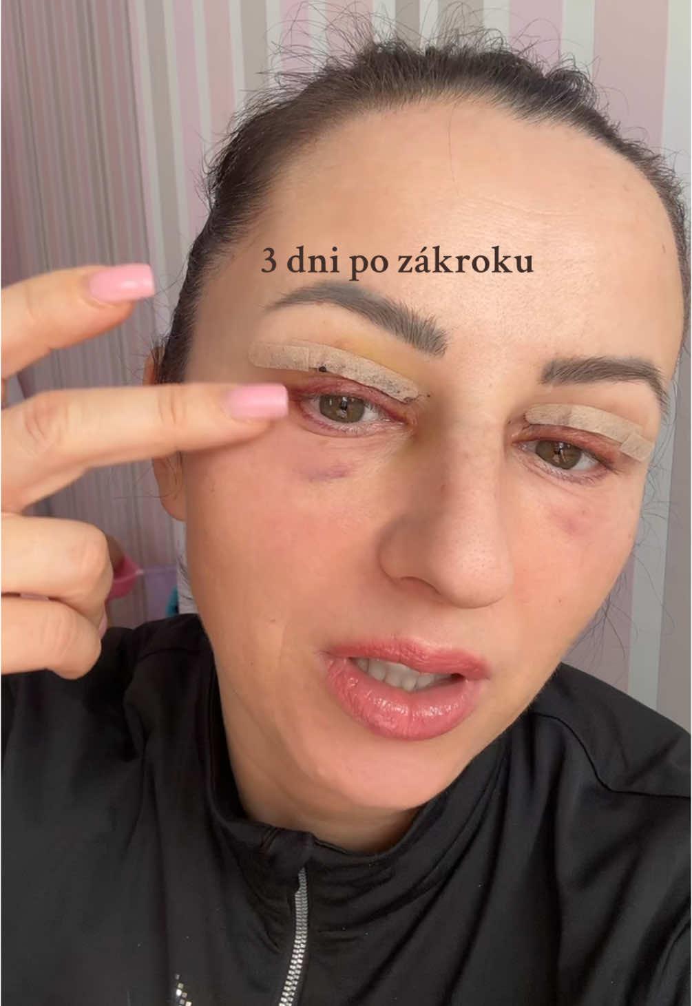 3 dni po zakroku #blefaroplastikabaku #blefaroplastia 