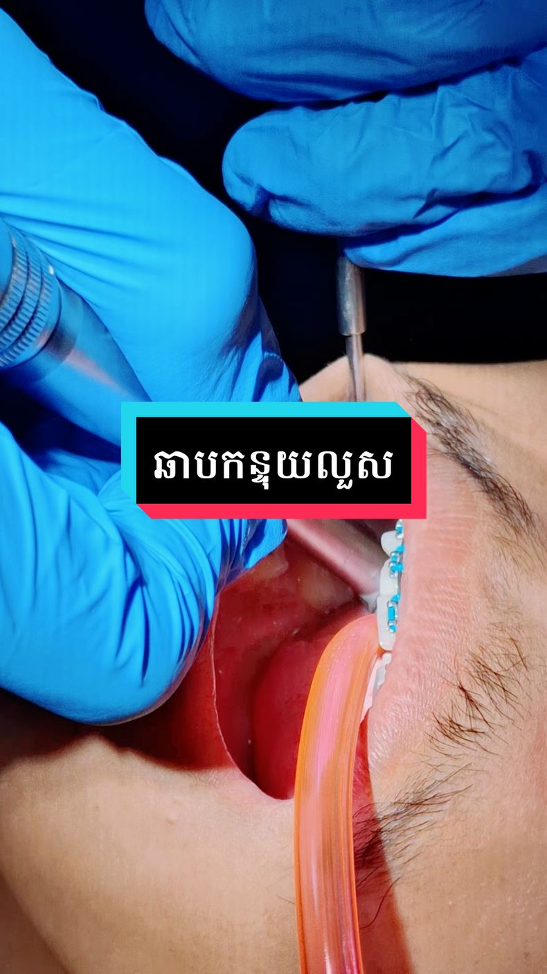 check up ឆាបកន្ទុយលួស  #greatsmiledental #គ្លីនិកធ្មេញគ្រេតស្មាល #teamធ្មេញដែក #greatsmile #fyp #braces #greatsmiledentalcambodia 