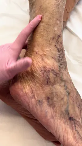 #clinicadrahelenpessoni #foryou #fypage #varizessemcirurgia #varicoseveins #varizes #medicodevarizes #viral 