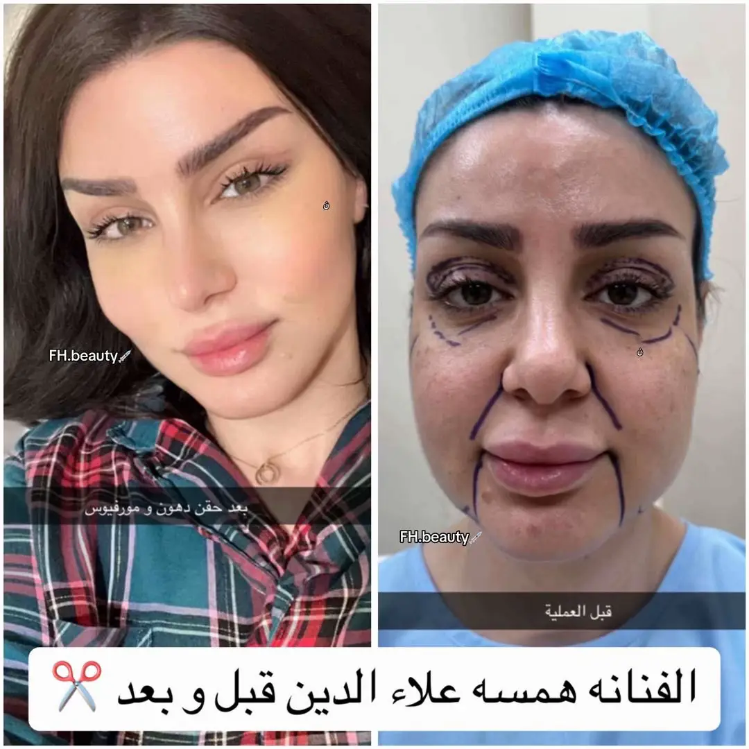 #همسه #تجميل_انف #عيادات_تجميل #تجميل #fy #viral #اكسبلورexplore #fypシ゚ #حنان_النجاده #foryou #foryoupage #الشعب_الصيني_ماله_حل😂😂 #ملكة_كابلي #مروج_الرحيلي #شد_البشرة #capcut #fypシ 