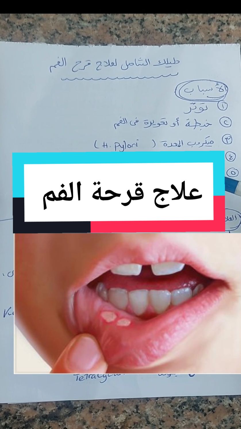 دليلك الشامل لعلاج قرح الفم  #دكتورة_السنان 