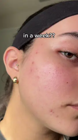 AD| you’ve seen bubbly cleansers but have you seen a bubbly toner?? I have been loving this one from Delphyr and recommend it if you want a hydrating, gentle, calming toner that’s mess free :) #acne #bubbletoner #delphyr #delphyrbubbletoner 