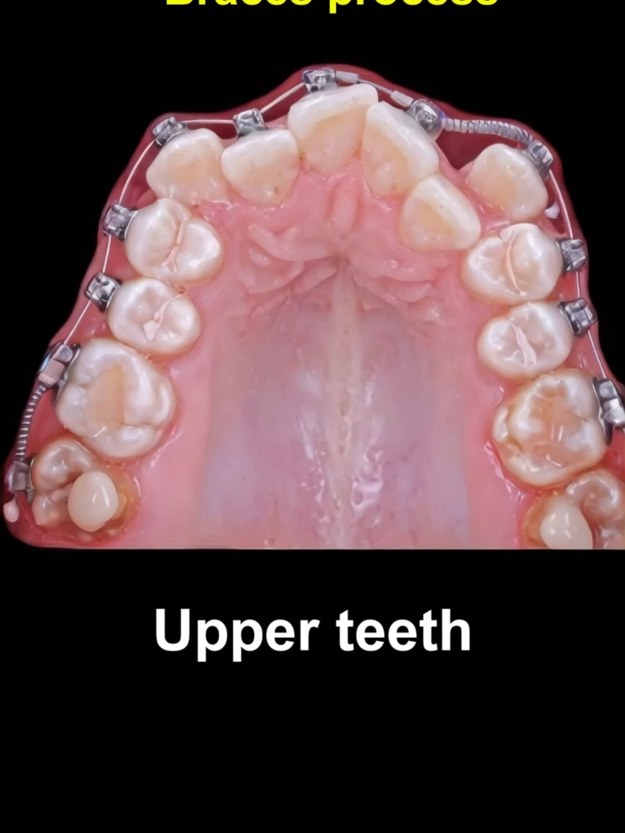 Braces transformation. 28 months duration #braces #orthodontist #dentist #dentistry #dental #dental 