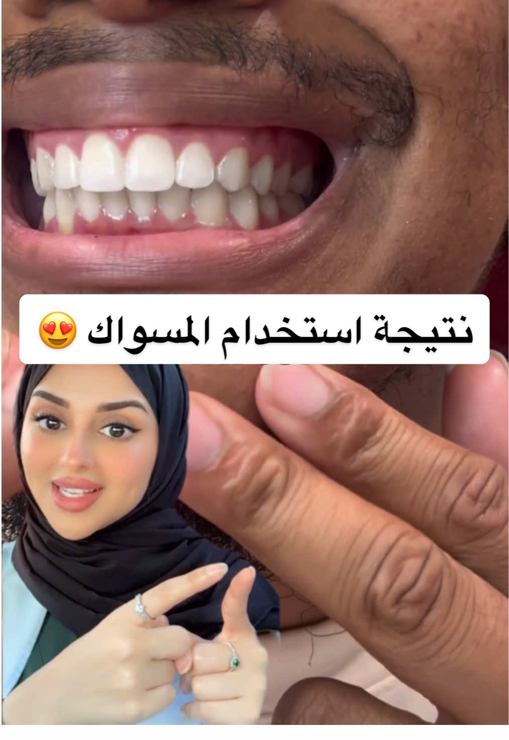 المسواك له فوائد عظيمة، ولكن ما نستغني عن الفرشاة والمعجون 👍🏻.                #dental #dentist #teeth #smile #teethwhitening #teethcare #video #viral #explore #fyp #trending #new #uae #kuwait #ksa #qatar #fu 