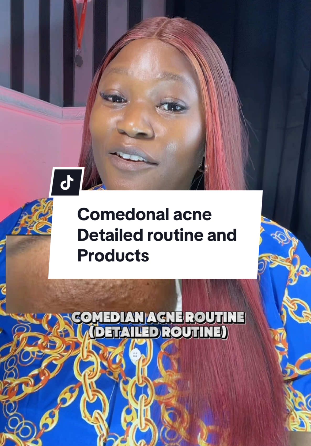 Do not rush your skin start slowly and work your way through to avoid irritation. #skincareproducts #skincareroutine #skincareroutinetips💕 #skincareroutinetips💕 #acneproneskin #acnetreatment #acnetreatment #acneskincare #acneskincareroutine #acneserummsglow #comedancewithme #comedonalacnetreatment #comedonalacne 