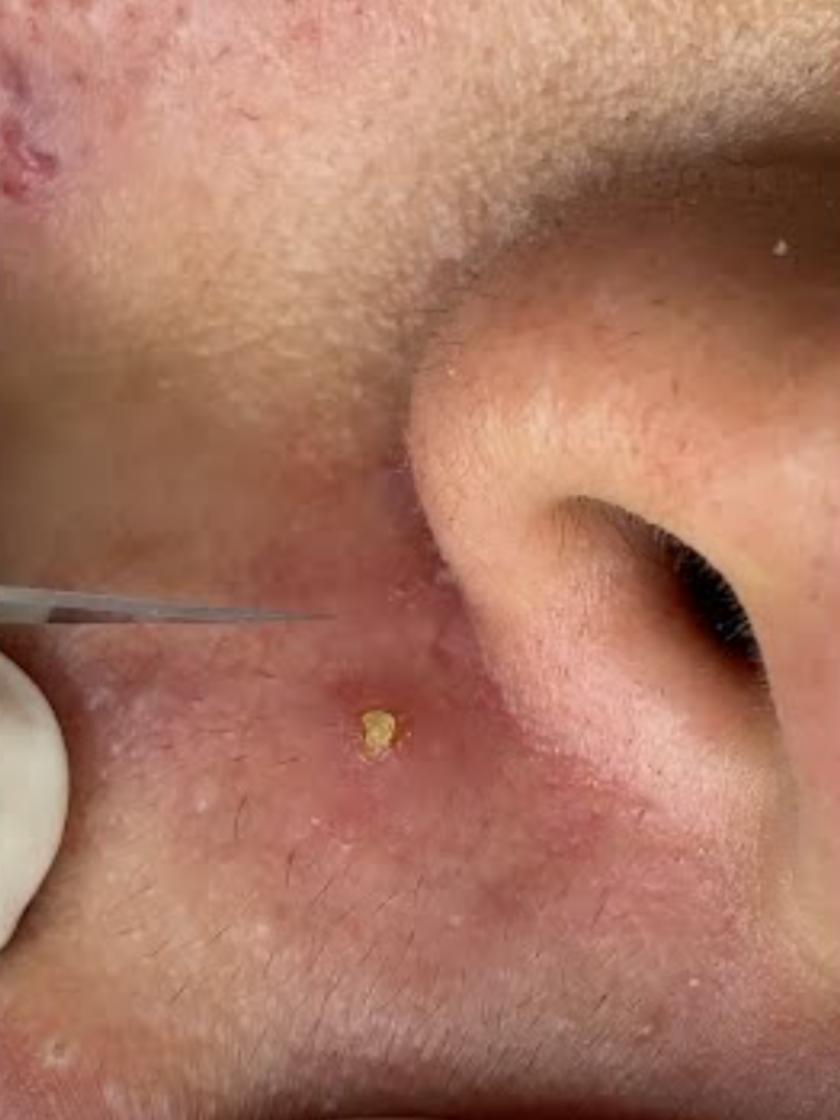 CRAZY SATISFYING BLACKHEAD REMOVAL  #blackhead #blackheads #satisfyingvideo #satisfyingvideos #viral_video #blackheadsremoval 