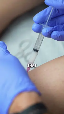 A steroid injection is a quick way to reduce pain and swelling in areas like your joints, muscles, or tendons. It’s like sending powerful medicine straight to the spot that hurts. The doctor cleans the area and uses a small needle to inject the medication, sometimes using a scanner to guide it. It can provide relief that lasts for weeks or even months, helping you move and feel better. #painmanagement #painrelief 