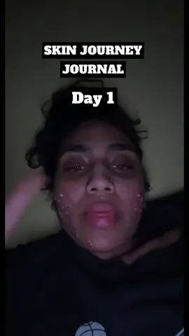 I actually cried making this😣 My acne journey was not easy and was one of the darkest times of my life but I am so glad I pushed through because looking back makes it all worth it. My dms are always open if you guys want to talk❤️ im all ears #acneskin #acnefighter #acnejourney #skincare #skintok #accutane #fighter #selflovejourney #fyp  @CeraVe @Cetaphil @La Roche-Posay 