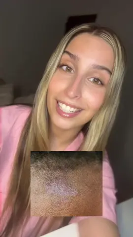 Para saber mas sobre la tiña capitis🍄‍🟫👇🏼 https://vm.tiktok.com/ZMhcxU929/