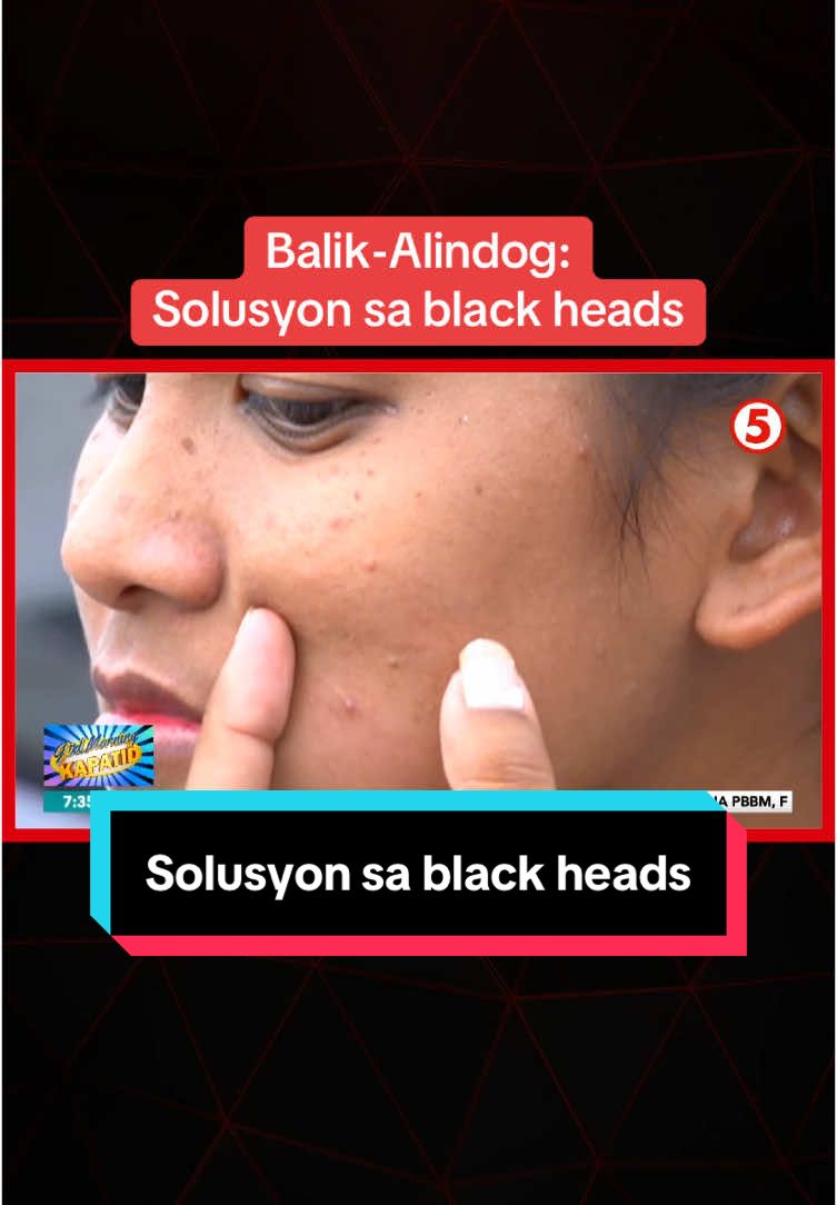 Ilan sa ating mga Kapatid ay nababahala sa pagkakaroon ng black heads. Ano nga ba ito at ang solusyon sa black heads? 'Yan ang tinalakay ni Doc. #RichardValGadiaza. #GudMorningKapatid #News5 #NewsPH #SocialNewsPH #BreakingNewsPH #GuMKBalikAlindog 