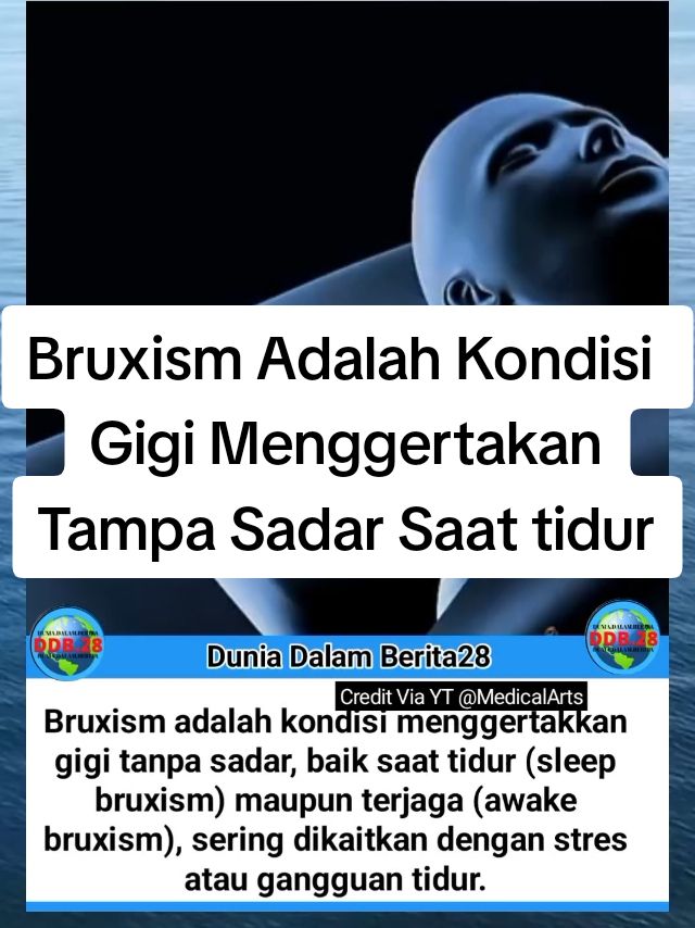 Bruxism Adalah Kondisi Gigi Menggertakan Tampa Sadar Saat tidur #fyppppppppppppppppppppppp #Bruxism 