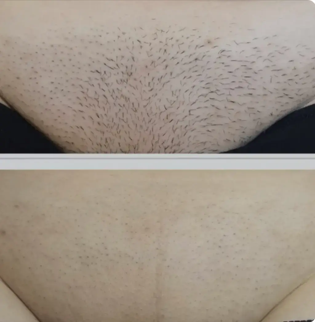Are you tired of shaving and waxing? Would you like to avoid razor bumps, ingrown hairs, and acne-like breakouts when you shave? Laser hair removal does all that and more.We can help you get rid of hair permanently with  laser treatment at our clinic. Experience a 70% to 90% permanent removal of unwanted hair in just six treatments + and free yourself from the constant and endless cycle of shaving, waxing, or plucking. We utilize multiple laser technologies so we can safely treat all skin types and hair textures. A laser hair removal program that provides you with the safest, most effective results possible. Please note Laser Hair Removal cannot be performed over tattoos. #blackfriday #laserhair #laserclinic #Glasgow