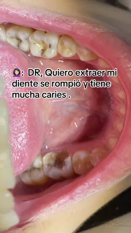 La extracion de diente , siempre sera MI ULTIMA OPCIÓN . #parati #caries #odontologo #fypシ゚ #extraciondental 