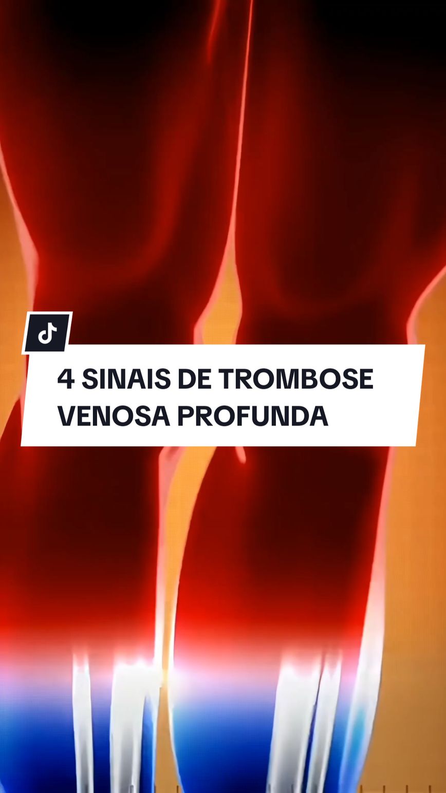 4 SINAIS DE TROMBOSE VENOSA PROFUNDA.