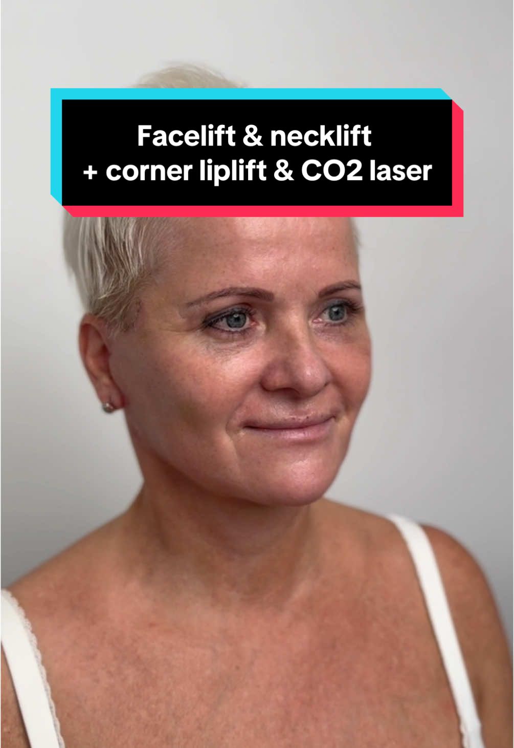 2 weeks after deep plane facelift, deep necklift, corner lip lift and CO2 laser skin resurfacing👌 All done under local anesthesia😉 📲 If you want to make an appointment, contact us at contact@v-clinic.cz #facelift #necklift #cornerliplift #co2 #plasticsurgery #plasticsurgeon #plastickachirurgie #ventruba #vclinic #transformation #beforeandafter