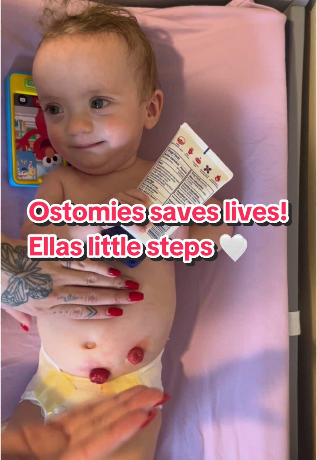 Bath and ostomy change every other day  On no bath days we do wipe downs, ellas not the biggest fan of ostomy bag changes #fyp #foru #sahmsoftiktok #ellaslittlesteps #bandannamama #kidneydisease #STARSYNDROME 