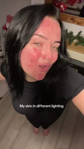 #acne #positivity #acnegirl #texturedskin #acneproneskin #confindence #acnefighter 
