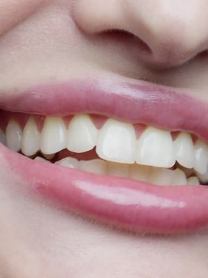 Clareamento dental em casa sem dor e sem sensibilidade com apenas 30 minutos por dia