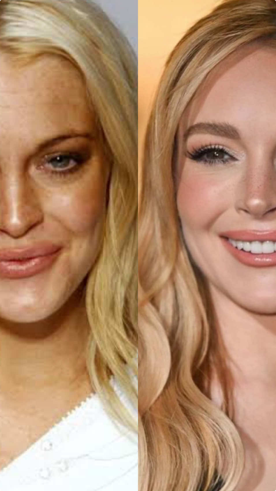 A beleza de Lindsay Lohan está entre os assuntos mais comentados na última semana na medicina estética.  Neste “antes e depois” vemos uma Lindsay que fez boas escolhas e transformou não apenas a sua aparência exterior. É nítida a mudança de hábitos, estilo de vida, mentalidade. Como médica dermatologista que trabalha com estética, vou listar para vocês o que ela possivelmente realizou: ▫️remoção do excesso de preenchimento, que deixava o rosto pesado e artificial. Manteve os pontos estratégicos que iluminam e embelezam, como o tratamento das olheiras, leve projeção do queixo, lábios mais naturais. ▫️botox para suavizar as linhas de expressão, abertura do olhar e melhorar a definição do contorno facial. ▫️luz pulsada e laser fracionado, responsáveis pelo clareamento das sardas, melhora da textura da pele. ▫️estímulo de colágeno associado ao biorremodelador como Profhilo, que ajudam a colar a pele e hidratar profundamente. ▫️ela perdeu peso e colocou lentes nos dentes.  O processo de transformação com os cuidados certos começou em 2020. A prova de que os procedimentos estéticos quando bem indicados e executados fazem muita diferença! E os resultados são construídos gradativamente. #lindsaylohan #beforeandafter #harmonizaçãofacial #piracicaba #dranelisamaciel 