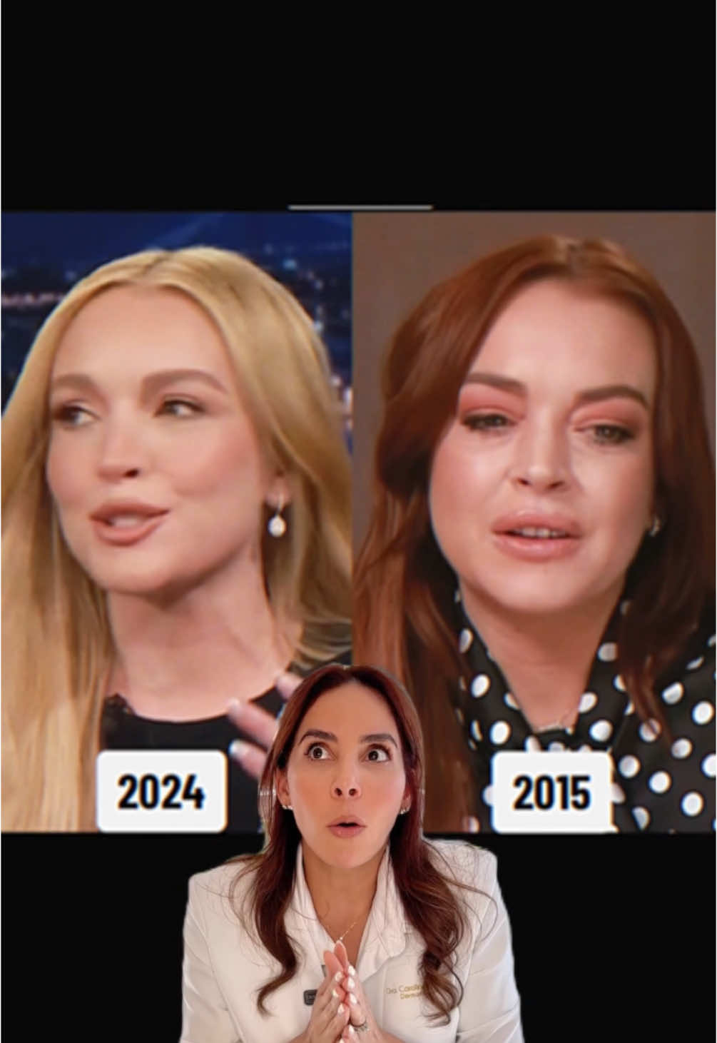 ¿Te has preguntado qué se hizo Lindsay Lohan para lucir tan increíble? En este video te explico los secretos detrás de su transformación y cómo los bioestimuladores como Radiesse y HarmonyCa pueden estimular la producción de colágeno, logrando un rostro más joven y radiante. ¡Descubre cómo funcionan y por qué son los favoritos de muchas celebridades! 💉✨ #Bioestimuladores #Colágeno #Radiesse #HarmonyCa