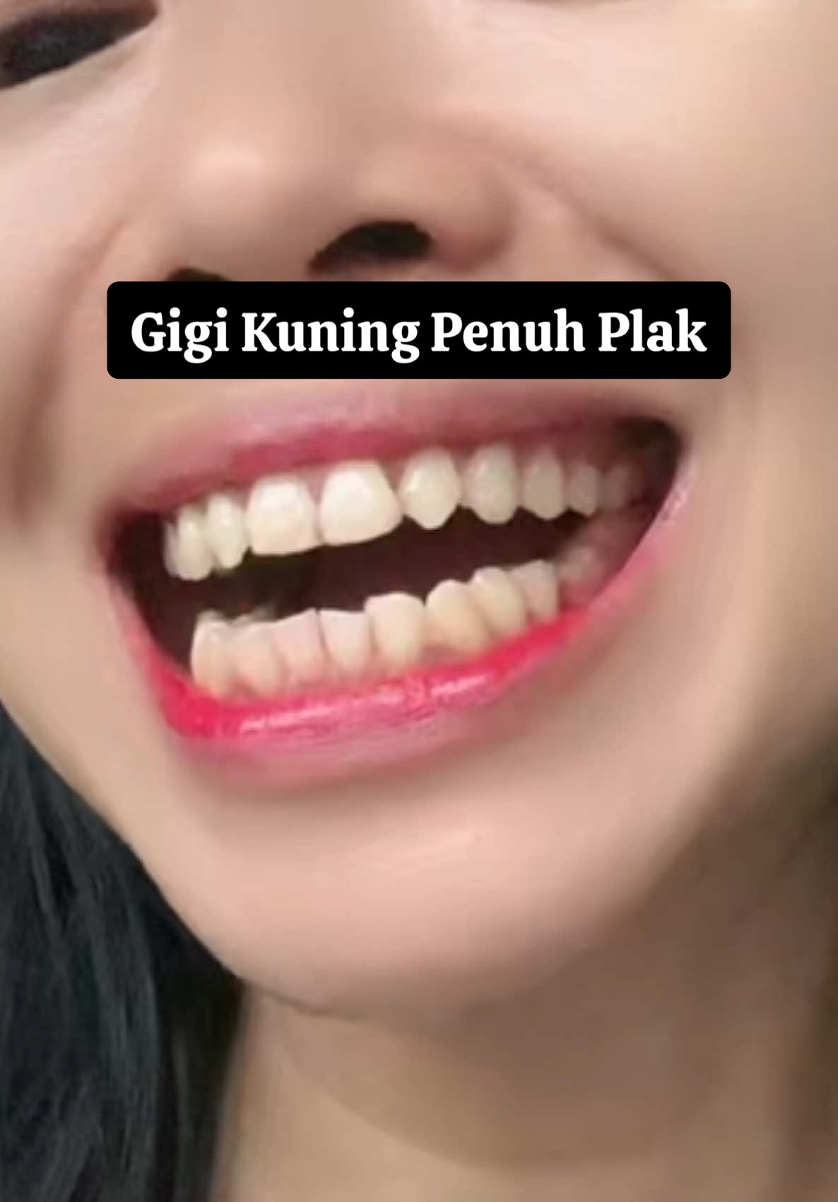 Gigi kuning 