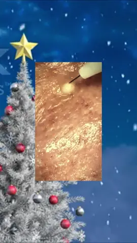 #squeezeyuk #satysfying #pimple #foryou #relax