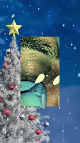 #squeezeyuk #satysfying #pimple #foryou #relax