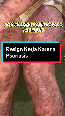 Hai Psoriasis Warrior…  Tgl 29 Oktober kemarin diperingati sebagai Hari Psoriasis Sedunia. Aku sendiri sudah lebih dr 7 tahun berjuang dan berdampingan dengan #autoimun #psoriasis Pekerjaan sabagai banker akhirnya aku tinggalkan, karena tahun 2023 kemarin merupakan tahun terberatku, Psoriasis ku kambuh dan menutupi 95% badan ku.  Setelah mencoba berbagai macam pelembab untuk merawat kulit ku, akhirnya ada salah satu yang aku suka, NOROID, pelembab yg sudah di rekomendasikan oleh banyak dokter kulit di Indonesia. Kandungan Pseudo - Ceramide nya sangat aman untuk di gunakan sesering mungkin untuk menjaga kulit tetap lembab. @Noroid Official bisa jadi pilihan untuk meredakan kemerahan kulit sobat psoriasis ya 🥰 ❤️Happy Psoriasis Day ❤️ You Are More Than Your Psoriasis…. #NOROIDTheRealMVP #psoriasisawareness #psoriasiswarrior #autoimmune #reels #fyp #fypシ 