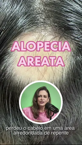 Voce ja ouviu falar em alopecia areata? Venha entender isso comigo! #alopecia #alopeciareata  #dicasdesaude  #dermatologistabh 