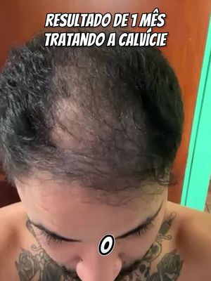 Queda de Cabelo tem tratamento!