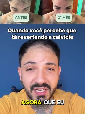 Queda de Cabelo tem tratamento!