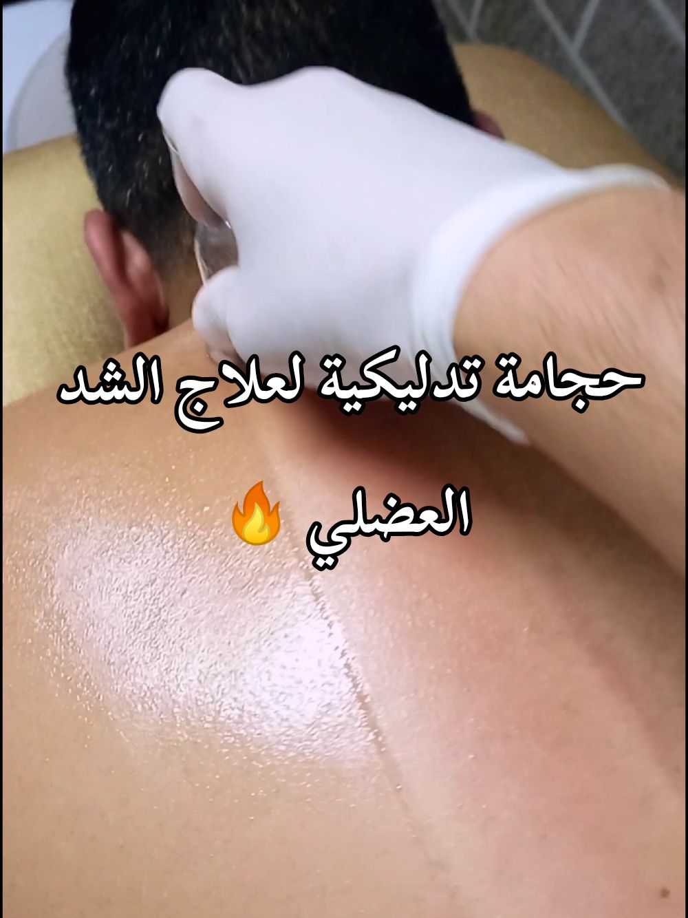 حجامة تدليكية لعلاج الشد العضلي #الحجامة_النبوية #الحجامة_شفاء #الحجامة_العلاجية #حجامة_جافة #حجامة #الحجامة #cupping #الحجام #hijama 