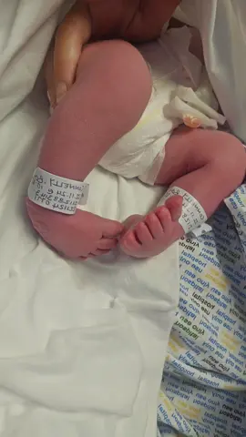 We are so lucky that Corr has no other complications relating to the talipes and this is easily fixed with casts then a boot and bar. Casting starts next week #talipesbaby #talipesawareness #fyp #ponsetimethod  #babycasting 