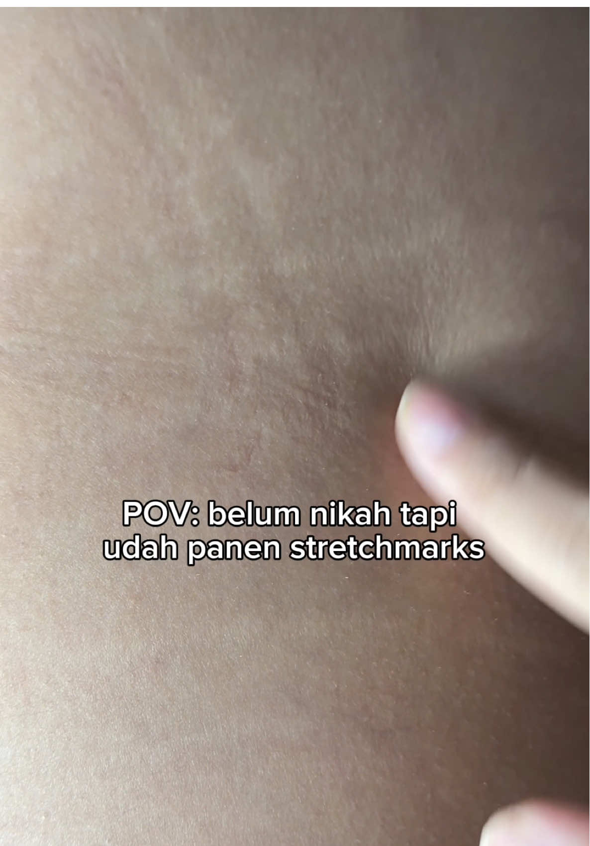 Gausa khawatir lagi kalau kalian punya stretchmark! nonton sampai habis udah aku spill ya produknyaa🥰 #stretchmarks #stretchmark #stretchmarkserum #stretchmarkoil #ciaraindonesia 