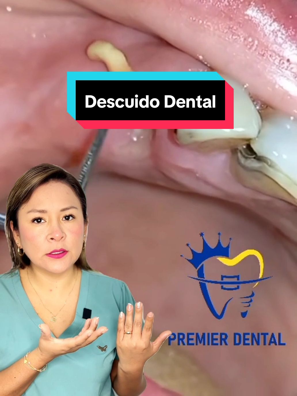 La acumulación de placa y sarro puede llevar a problemas graves si no se trata a tiempo. ¡No olvides tu limpieza dental regular para mantener una sonrisa saludable y libre de  acumulaciones! #duo con @Dentist Premier  📥Escríbenos al interno o dale clic al enlace de nuestro perfil. #SaludDental #SuciedadDental #SonrisaPerfecta #Dentista #SonrisaSegura #Viral