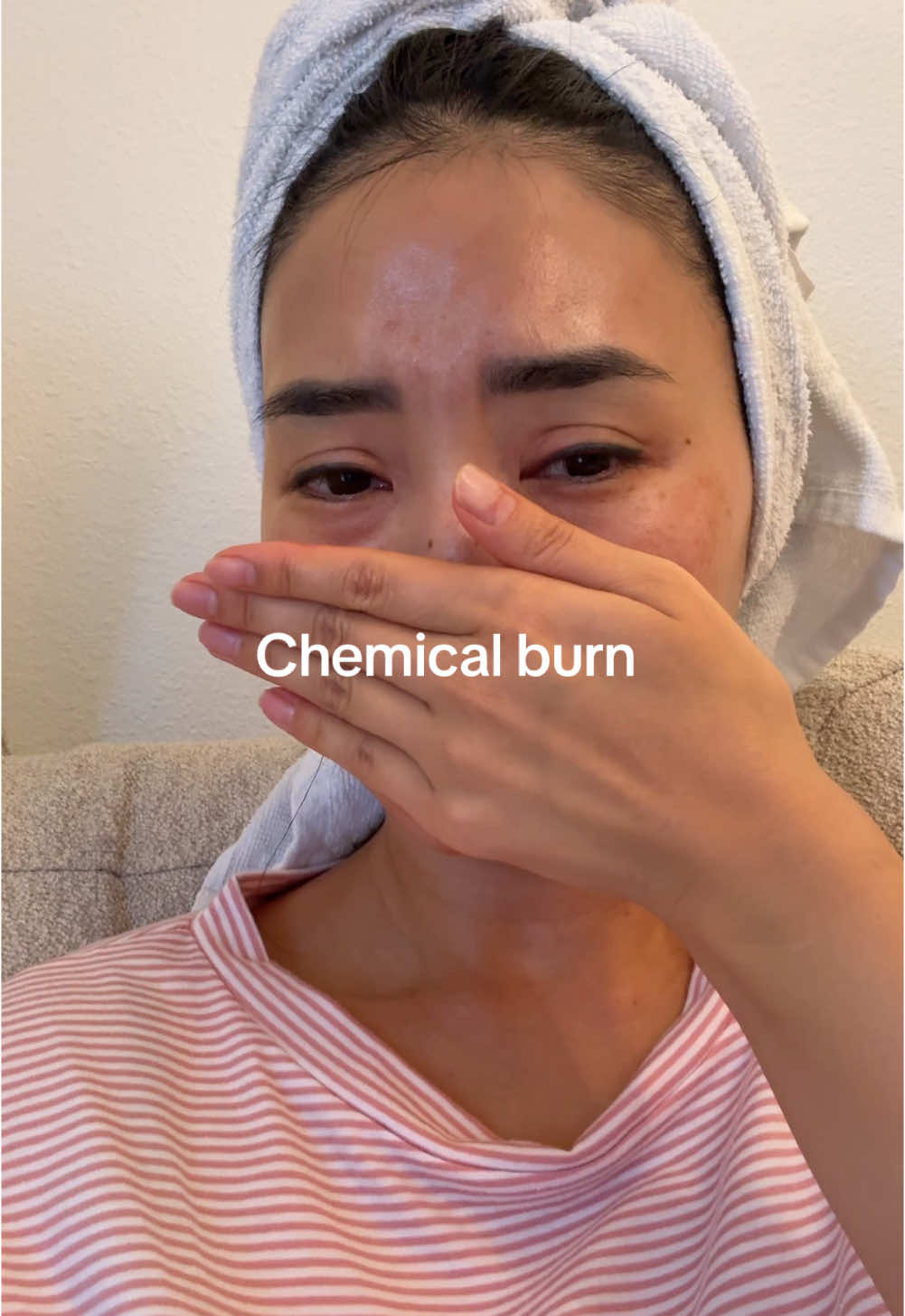 Happy Thanksgiving! 🦃 I want to share an important reminder with everyone. Yesterday, I ended up with a chemical burn, and today it got worse. 😞 Please, always be careful when trying something new: ✨ Check the ingredients. ✨ Test a small amount on your skin first. ✨ If you feel any stinging or discomfort, wash it off immediately. Take care of yourselves and stay safe! 💛 #skincare #chemicalburn #care #Love 