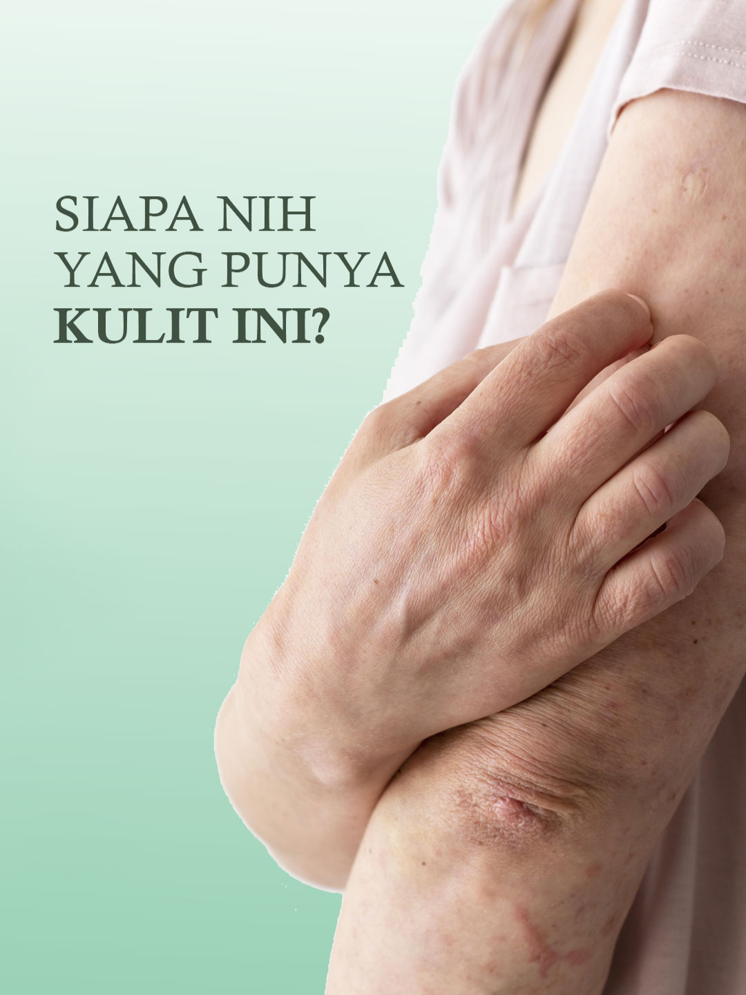 siapa nih yang punya kulit ini? #biduran#gatal#masalahkulit#rekomendasi#miels #bodycare#bodybutter#fyp#trending