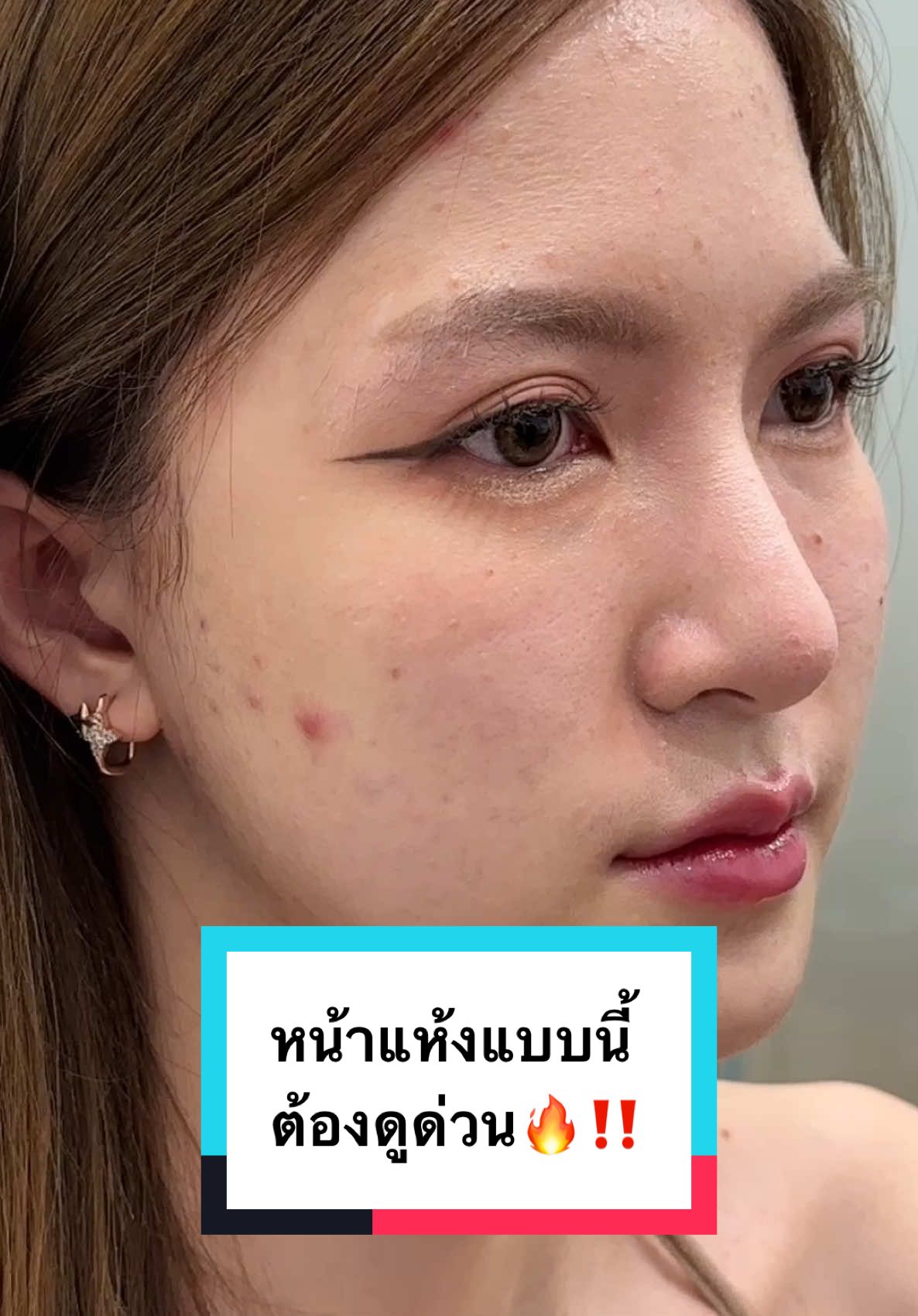 รีตูรันกล่องแดงทำถึง ได้ผิวจึ้งๆฉ่ำวาวแน่นอน‼️ #รีวิวฉีดหน้า #รีวิว #รีวิวบิวตี้ #รีวิวบิวตี้ในtiktok #รีวิวบิวตี้tiktok #รีวิวไปเรื่อย #รีจูรัน #รีวิวฉีดหน้า #รีวิวรีจูรัน #รีจูรันหน้าใส #ผิวชุ่มชื้น #ผิวชุ่มชื้นเรียบเนียน #ผิวชุ่มชื้นกระจ่างใส #ผิวฉ่ำ #ผิวฉ่ำโกลว์ #ผิวฉ่ำวาว #ผิวละเอียด #ผิวเนียน #ผิวเนียนใส 