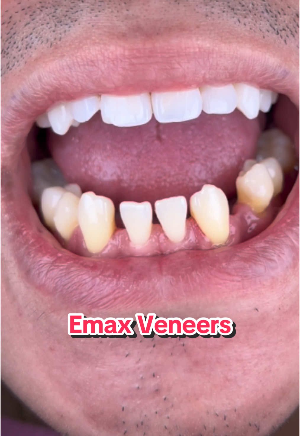 Lower teeth needs attention too!☺️ Patient has congenitally missing 2 incisors and is decided to have veneers to mask those spaces. #veneers #emax #emaxveneers 