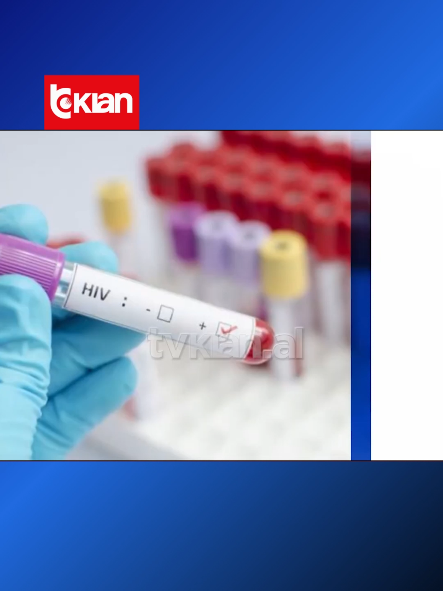 Mbi 1700 raste me HIV në Shqipëri LEXO MË SHUMË NË TV KLAN.AL #tvklan #news #shendeti #hiv #statistika