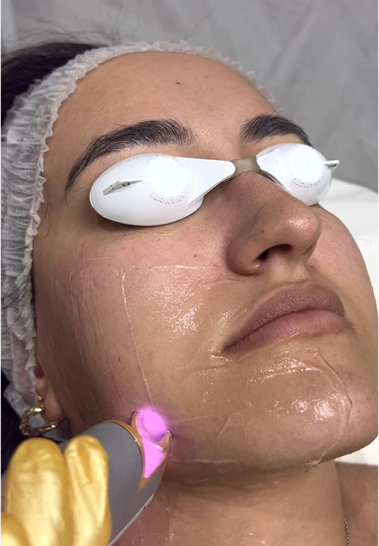 Now is the perfect time to start your laser hair removal journey—winter is ideal for this treatment! ❄️ Our advanced laser precisely targets unwanted facial hair on the cheeks, chin, and around the mouth, giving you smooth, hair-free skin just in time for spring. By starting now, you’ll have plenty of time to complete your sessions while protecting your skin from summer sun exposure. Laser hair removal also helps refine skin texture over time, so you’ll be glowing and confident by the time the warmer months arrive. ✨ Let’s make facial hair a thing of the past—DM to book your consultation today 💖 . . . . #laserhairremoval #laserhairremovaltreatment #laserhair #laserfacial #facehair #facialhair #facialhairremoval #laserfacials 