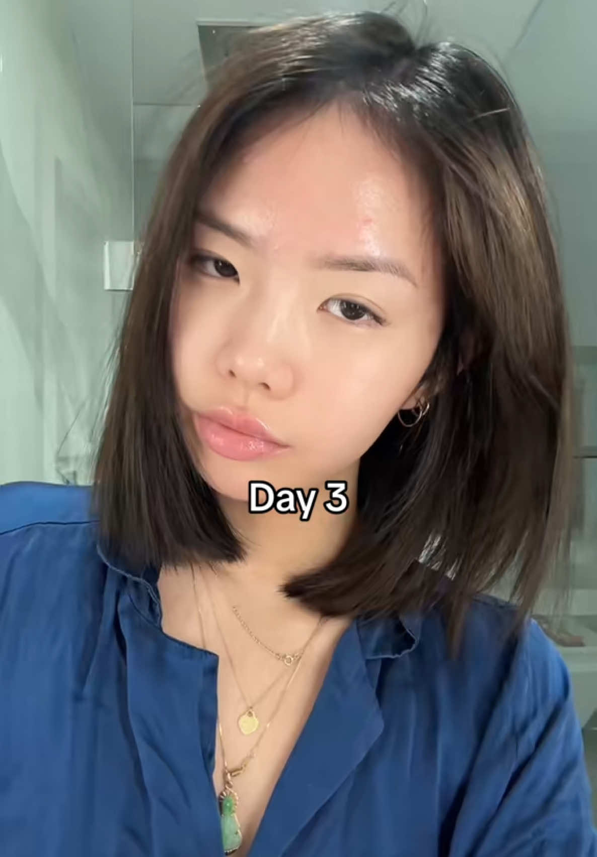 ✨ From acne struggles to glass skin in just 3 days! ✨ Say hello to clear, glowing skin with @bringgreen_official Zinc Teca Blemish Serum – your ultimate solution for pimples, pores, and oily skin. 💚  #GlowUp #glassskin #skincaremagic #amazon #koreanskincare #glassskin #acnecare #acneproneskin #acneremoval #poreremoval #oliveyoung