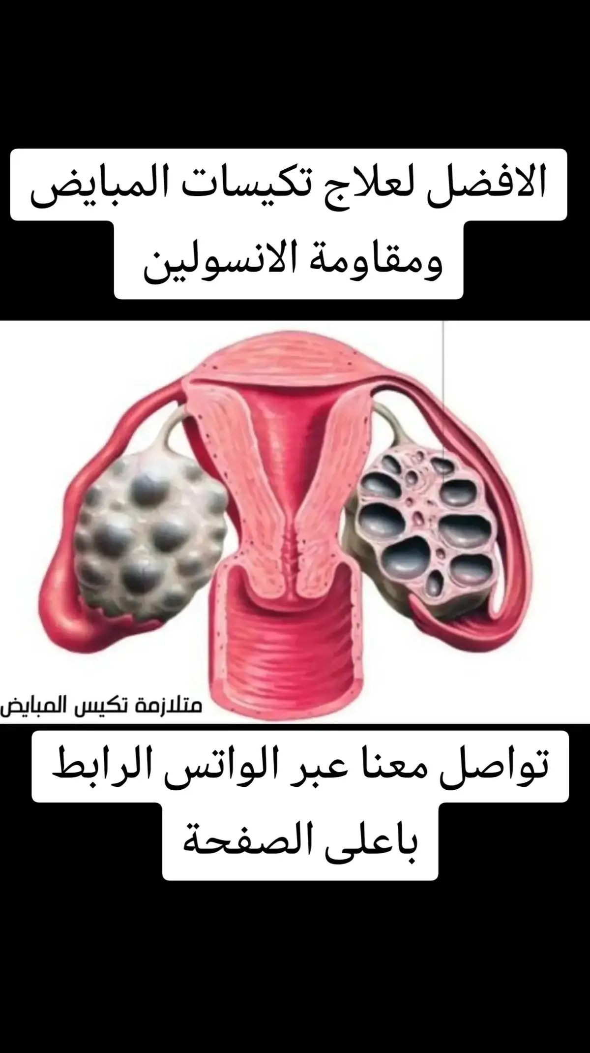 #لبنان_مصر_الخليج_سوريا #جدة_الان #تكيسات_المبيض #تكيسات_مبايض #تكيس #تكيسات_المبيض_والسمنة #الطائف_الان_مكة_جده_الرياض_ #الدمام_الخبر_الاحساء_الجبيل_الظهران #الشعب_الصيني_ماله_حل😂😂 #fyp #علاج_بالاعشاب #فرنسا🇨🇵_بلجيكا🇧🇪_المانيا🇩🇪_اسبانيا🇪🇸 #الحمل_والولادة #علاج_طبيعي 