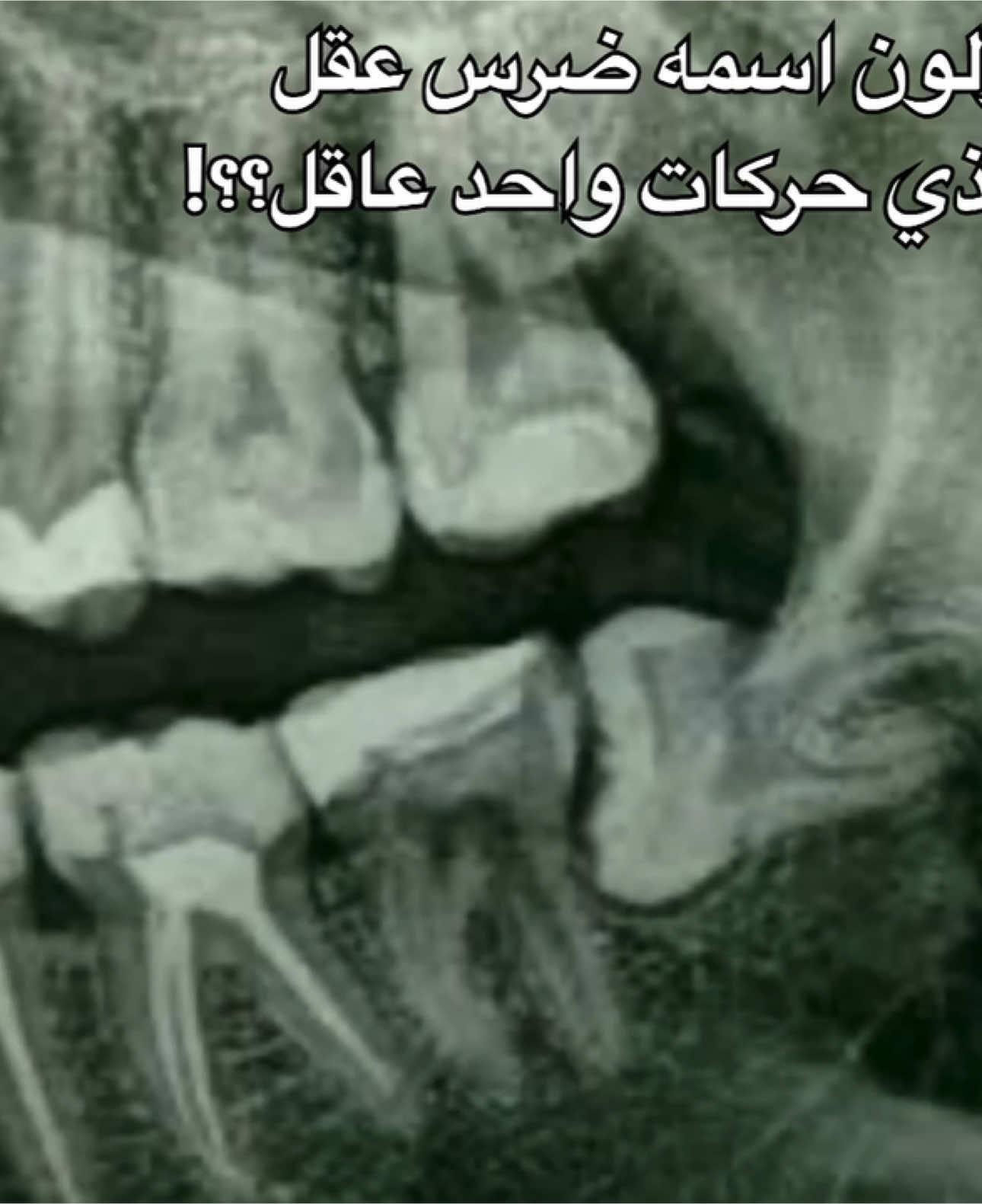 #ضرس_العقل باقي موجود ولا خلعتوه😵‍💫🤕؟ #مجمع_الميدان_الدولي_لطب_الأسنان #ابها #خلع #خلع_الاسنان #fpyツ #تريند #اكسبلورexplore #اكسبلوررر #اكسبلور #fyp 