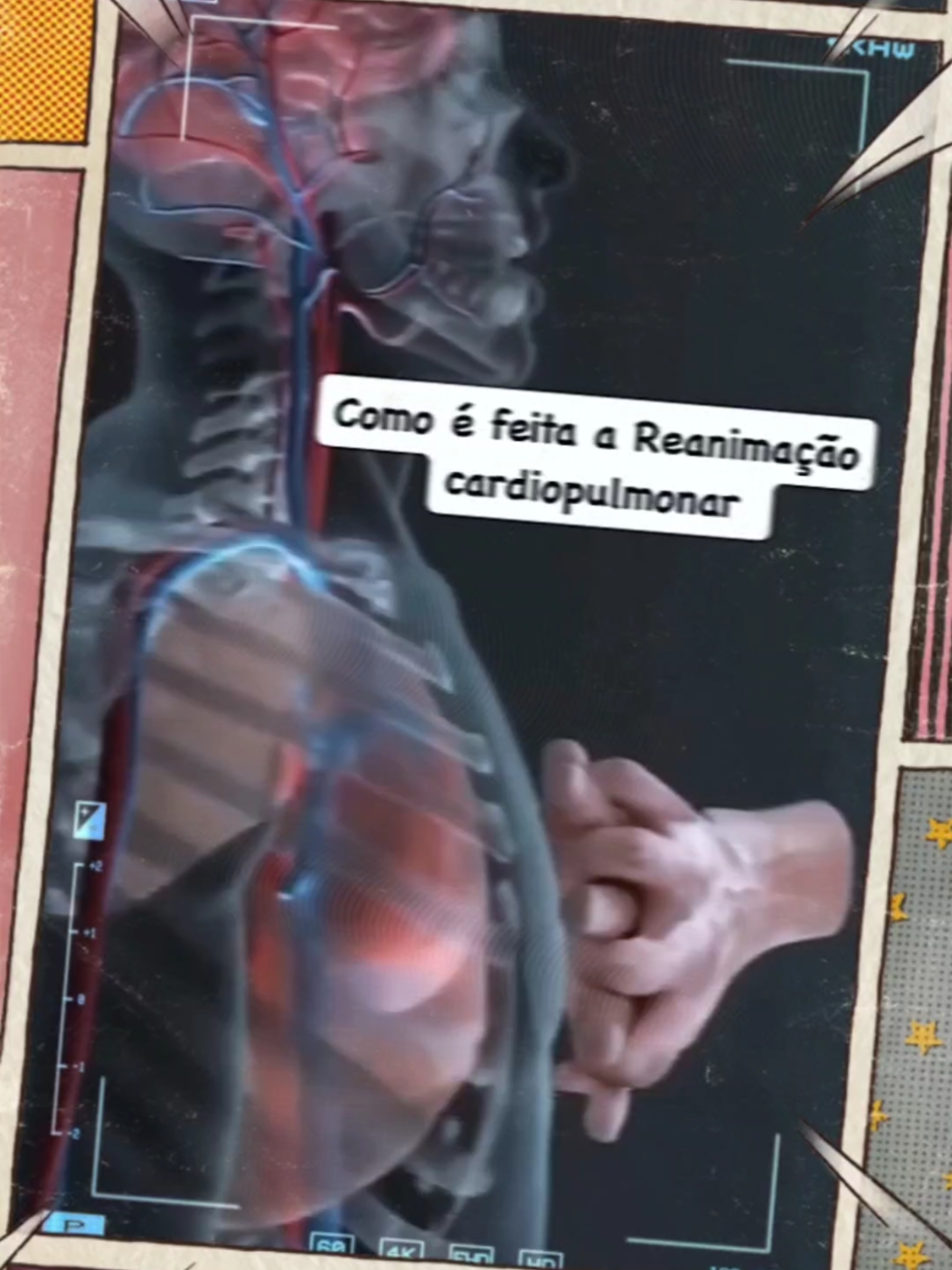 Veja o que acontece quando é feita uma RCP ( reanimação cardiopulmonar) Uma reanimação cardiopulmonar (RCP) é uma técnica de emergência usada para manter a circulação sanguínea e a respiração em uma pessoa que sofreu parada cardíaca ou respiratória . Aqui está um resumo do que acontece durante uma RCP: 1. Verificação de Responsividade: Primeiro, verifique se a pessoa está consciente e respirando Se a pessoa não responder e não estiver respirando, chame ajuda imediatamente 2. Início das Compressões Torácicas: Coloque uma mão no centro do peito da pessoa ea outra mão sobre a primeira 3. Realize compressões torácicas rápidas e profundas, aproximadamente 5-6 cm de profundidade, a uma taxa de 100-120 compressões por minuto . 3. Ventilação de Resgate: Após cada 30 compressões, dê duas respirações de resgate, inclinando a cabeça da pessoa para trás, levantando o queixo e selando sua boca com a dele . Sopre suavemente para encher os pulmões 4. Continuação das Compressões e Ventilações: Continue o ciclo de 30 compressões e 2 respirações até a chegada de ajuda especializada ou até que a pessoa comece a respirar novamente 5. Uso de Desfibrilador: Se houver um desfibrilador disponível, use-o conforme as instruções para tentar restaurar o ritmo cardíaco normal . A RCP é crucial para aumentar as chances de sobrevivência de uma pessoa em parada cardíaca, especialmente se realizada rapidamente e corretamente