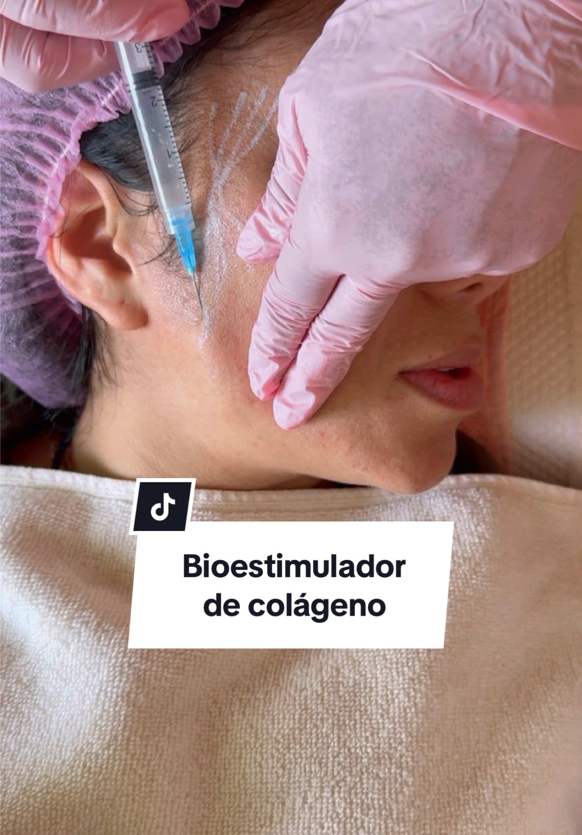 Bioestimulador de colágeno: el mejor efecto lifting que encontrarás con resultados notables en una sola sesión ¡Con la tecnología más avanzada! 🧏🏻‍♀️✨💖 #colageno #bioestimuladordecolageno #lifting #limaperu 