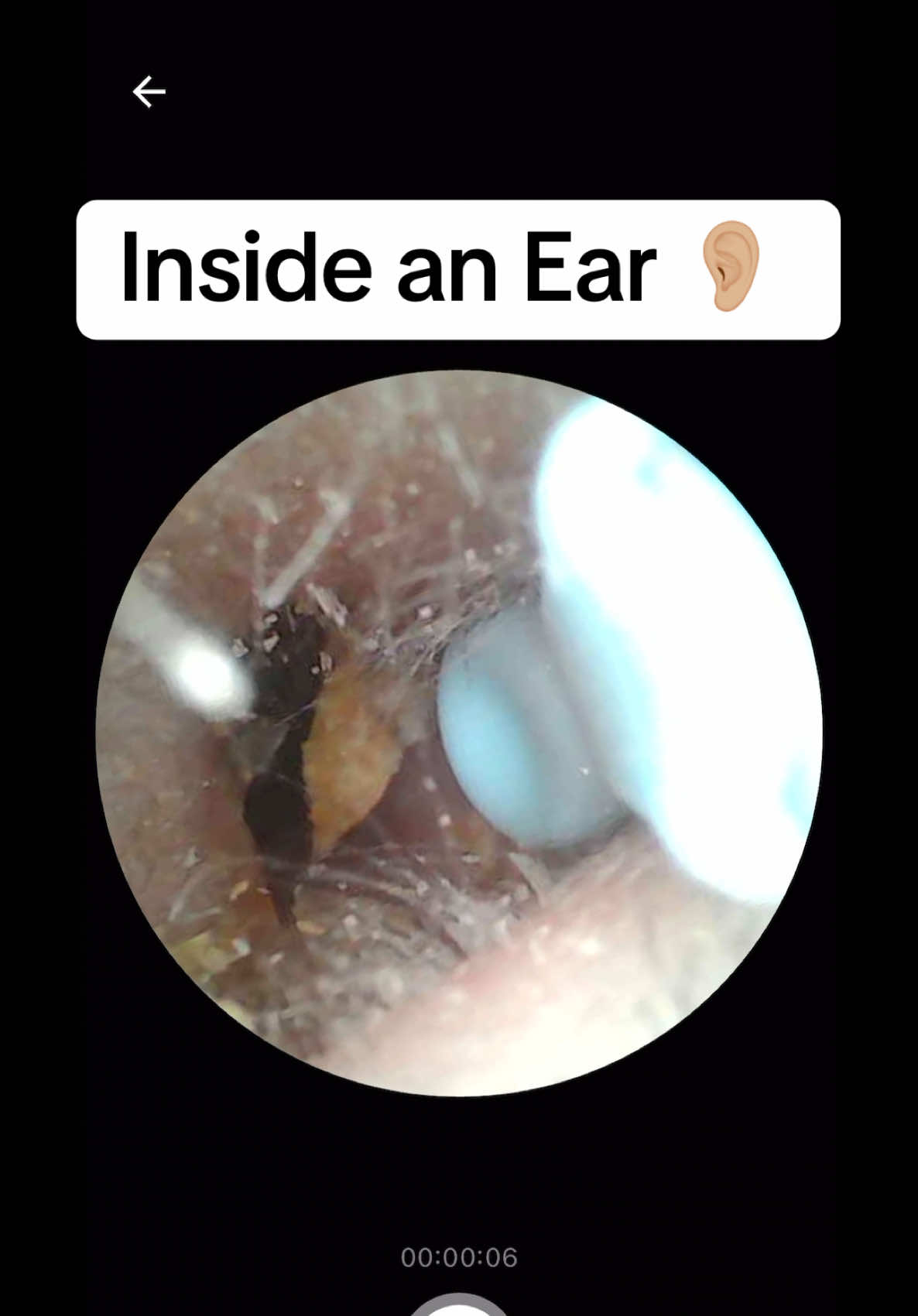 Ear wax removal ⚠️ #earwax #earwaxremoval #earwaxremmoval #ear #ears #gross #ttsdelightnow #treasurefinds #tiktokshopblackfriday #tiktokshopcybermonday #TikTokShop #fyp 